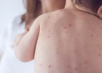 بعد مع تسجيل 120 حالة وفاة.. المغرب يعلن تحول مرض “الحصبة” إلى “وباء”