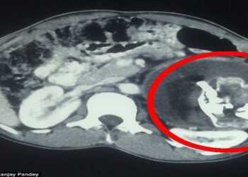 أفغانستان.. استخراج جنين من بطن رضيع !