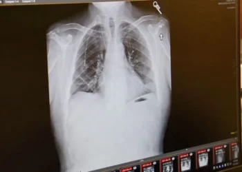 ليس التدخين فقط.. سبب آخر قد يسبب سرطان الرئة